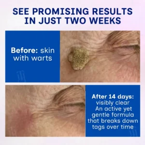 ❤️Valentine's Day Sale | RZXEA™ | Solid-Stick Wart Remover, Skin Tags in Just 48 Hours!