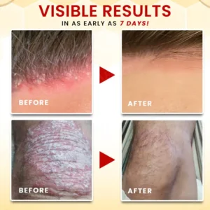 ⚡ New Year Flash Deals! 50% OFF - - RZXEA™ Bee Venom Psoriasis Treatment Cream
