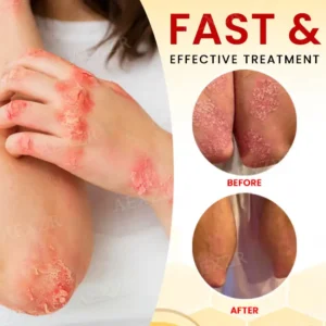 ⚡ New Year Flash Deals! 50% OFF - - RZXEA™ Bee Venom Psoriasis Treatment Cream