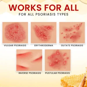 ⚡ New Year Flash Deals! 50% OFF - - RZXEA™ Bee Venom Psoriasis Treatment Cream