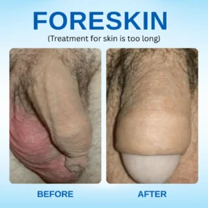 ⚡See Results in Just 24 hours: RZXEA™ Redundant Prepuce Corrector Gel